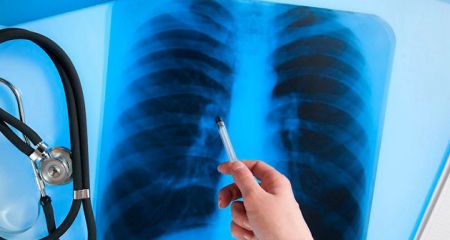 У Жовтих Водах кількість хворих на туберкульоз зросла в 2,5 рази